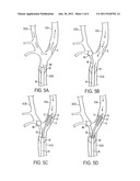 APPARATUS AND METHODS FOR REDUCING EMBOLIZATION DURING TREATMENT OF     CAROTID ARTERY DISEASE diagram and image