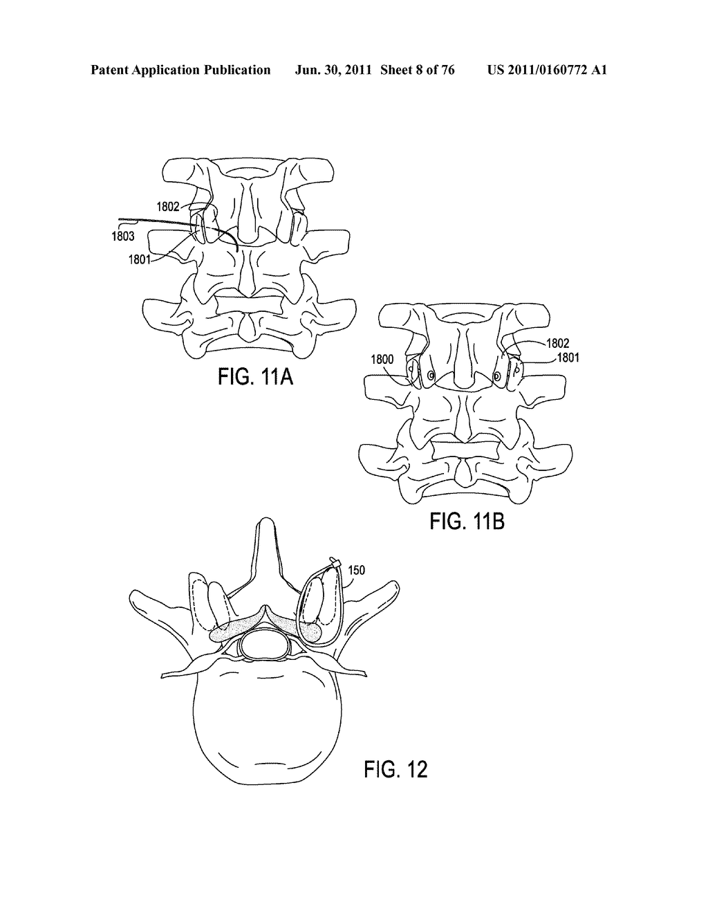 SYSTEMS AND METHODS FOR PERFORMING SPINAL FUSION - diagram, schematic, and image 09