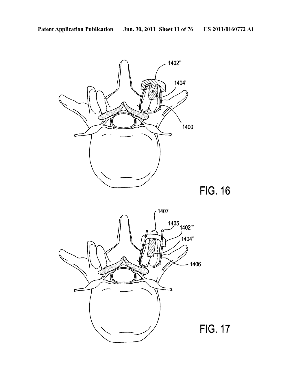 SYSTEMS AND METHODS FOR PERFORMING SPINAL FUSION - diagram, schematic, and image 12