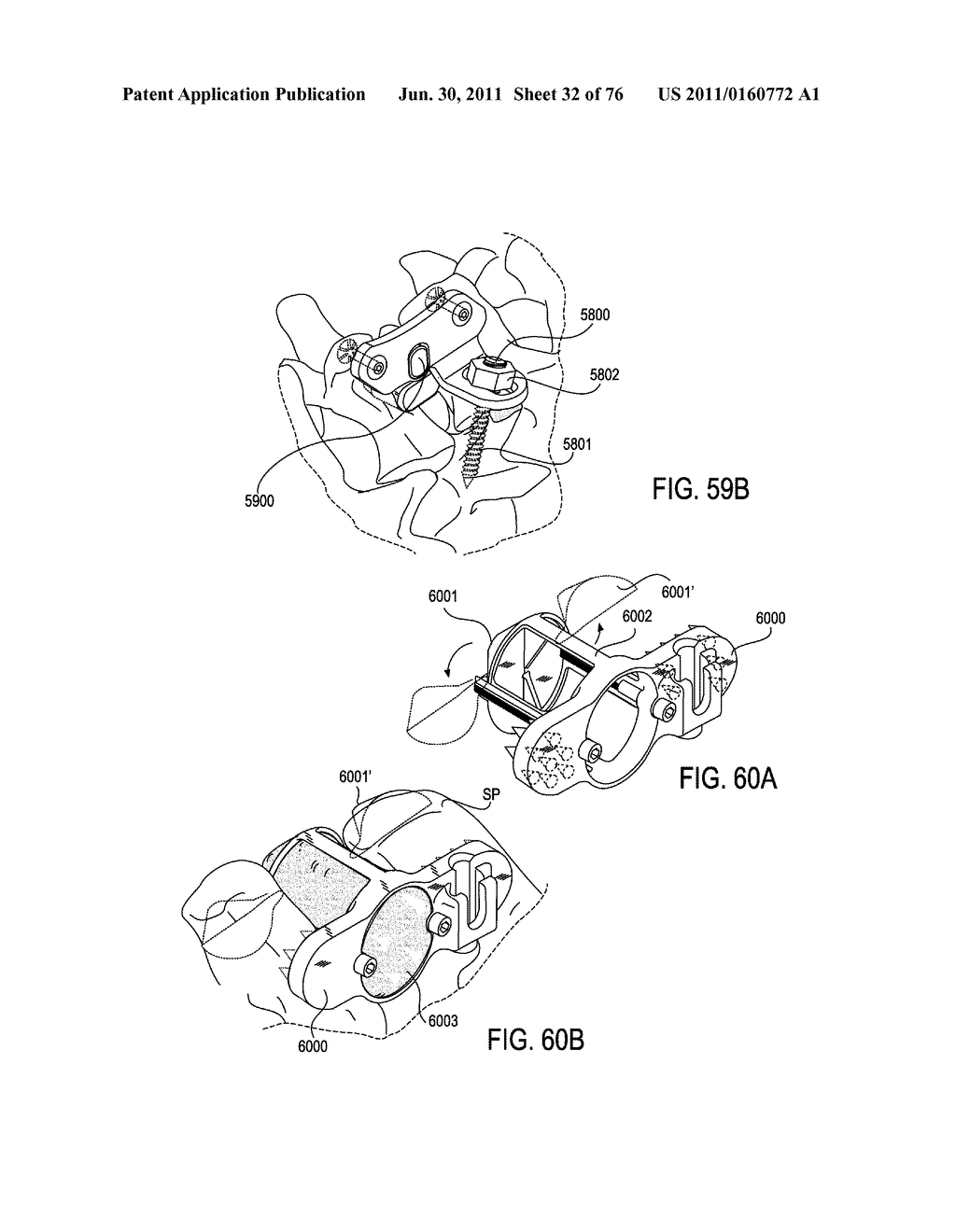 SYSTEMS AND METHODS FOR PERFORMING SPINAL FUSION - diagram, schematic, and image 33