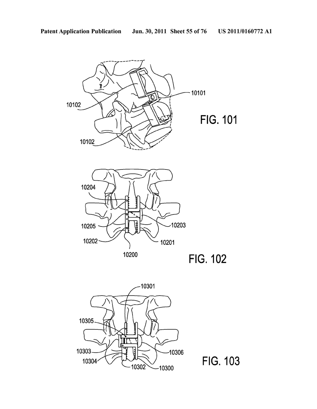 SYSTEMS AND METHODS FOR PERFORMING SPINAL FUSION - diagram, schematic, and image 56