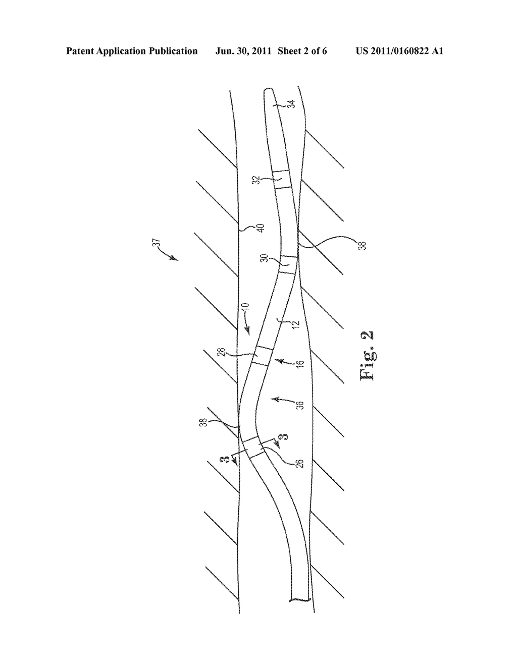 IMPLANTABLE LEAD ELECTRODE WITH ASYMETRICALLY DISTRIBUTED CURRENT DENSITY     AND METHODS FOR IMPARTING CURRENT DENSITY DIRECTIONALITY IN LEAD     ELECTRODES - diagram, schematic, and image 03