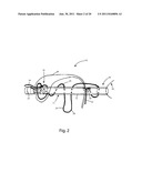 Systems and Methods for Zipknot ACL Fixation diagram and image