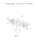 Systems and Methods for Zipknot ACL Fixation diagram and image