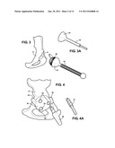 COMBINATION MALE/FEMALE HIP JOINT AND INSTALLATION KIT diagram and image