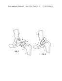 COMBINATION MALE/FEMALE HIP JOINT AND INSTALLATION KIT diagram and image