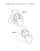 COMBINATION MALE/FEMALE HIP JOINT AND INSTALLATION KIT diagram and image