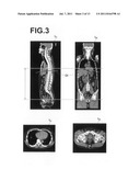 APPARATUS, METHOD, AND PROGRAM FOR DETECTING THREE DIMENMSIONAL ABDOMINAL     CAVITY REGIONS diagram and image