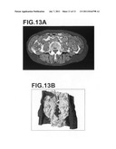 APPARATUS, METHOD, AND PROGRAM FOR DETECTING THREE DIMENMSIONAL ABDOMINAL     CAVITY REGIONS diagram and image