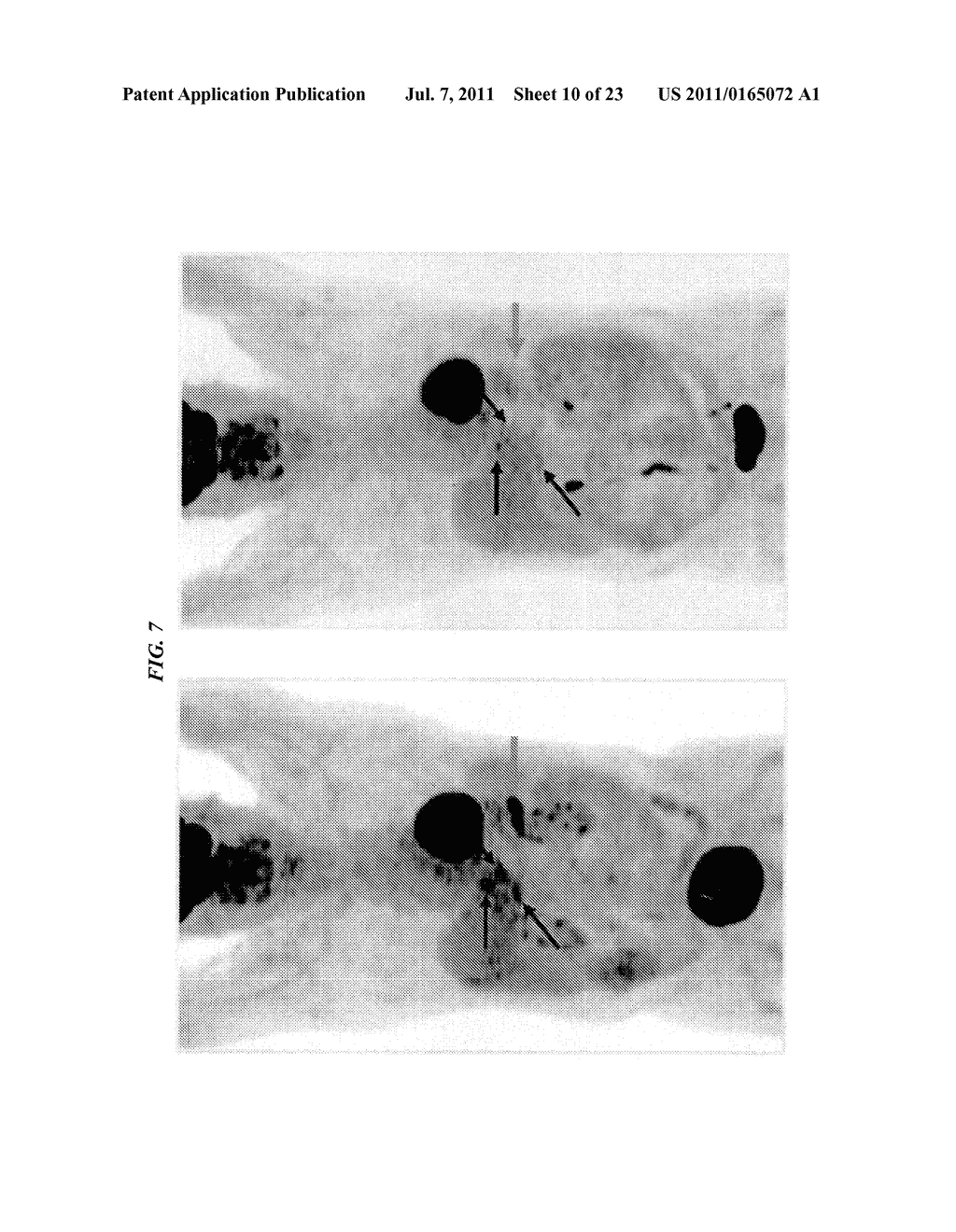 Detection of Early-Stage Pancreatic Adenocarcinoma - diagram, schematic, and image 11