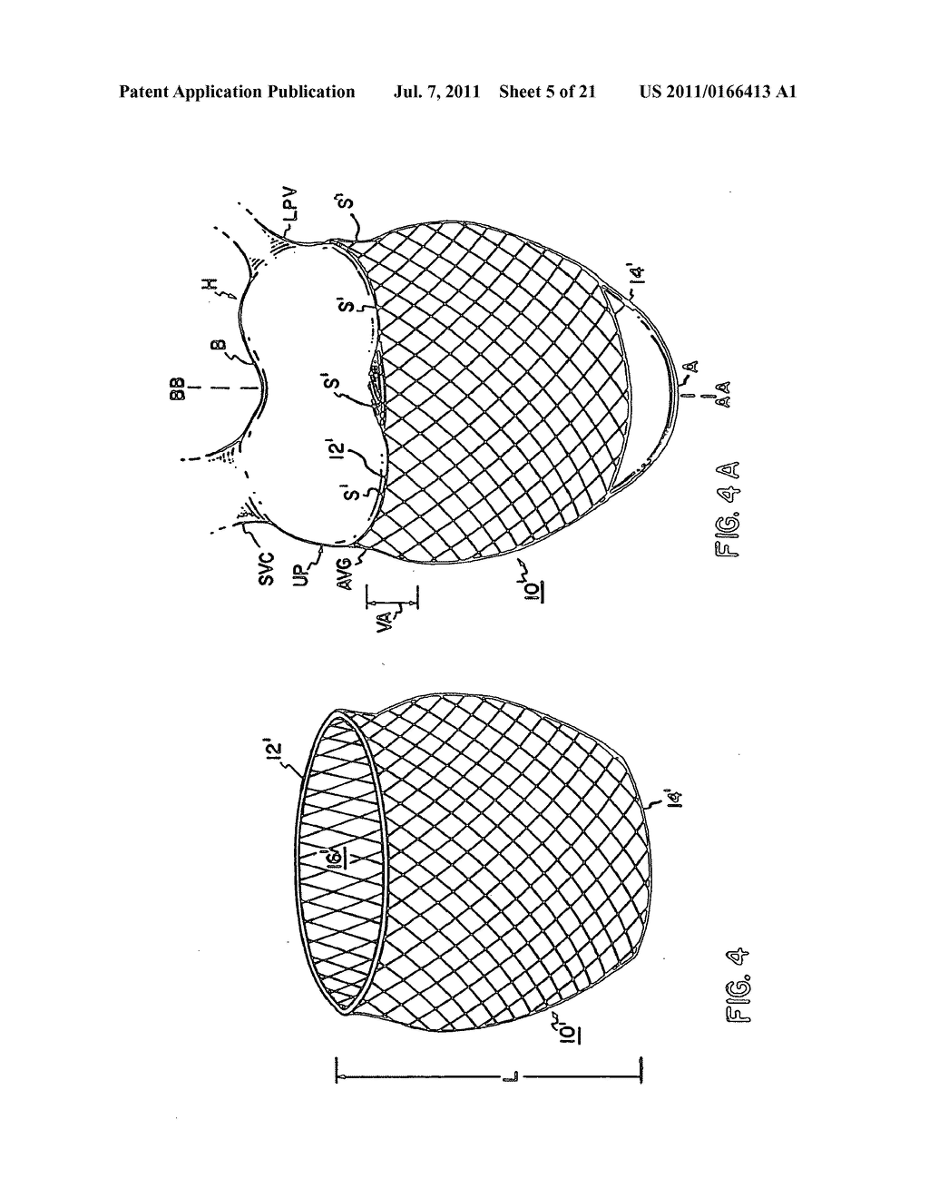 COMPLIANT CARDIAC SUPPORT DEVICE - diagram, schematic, and image 06