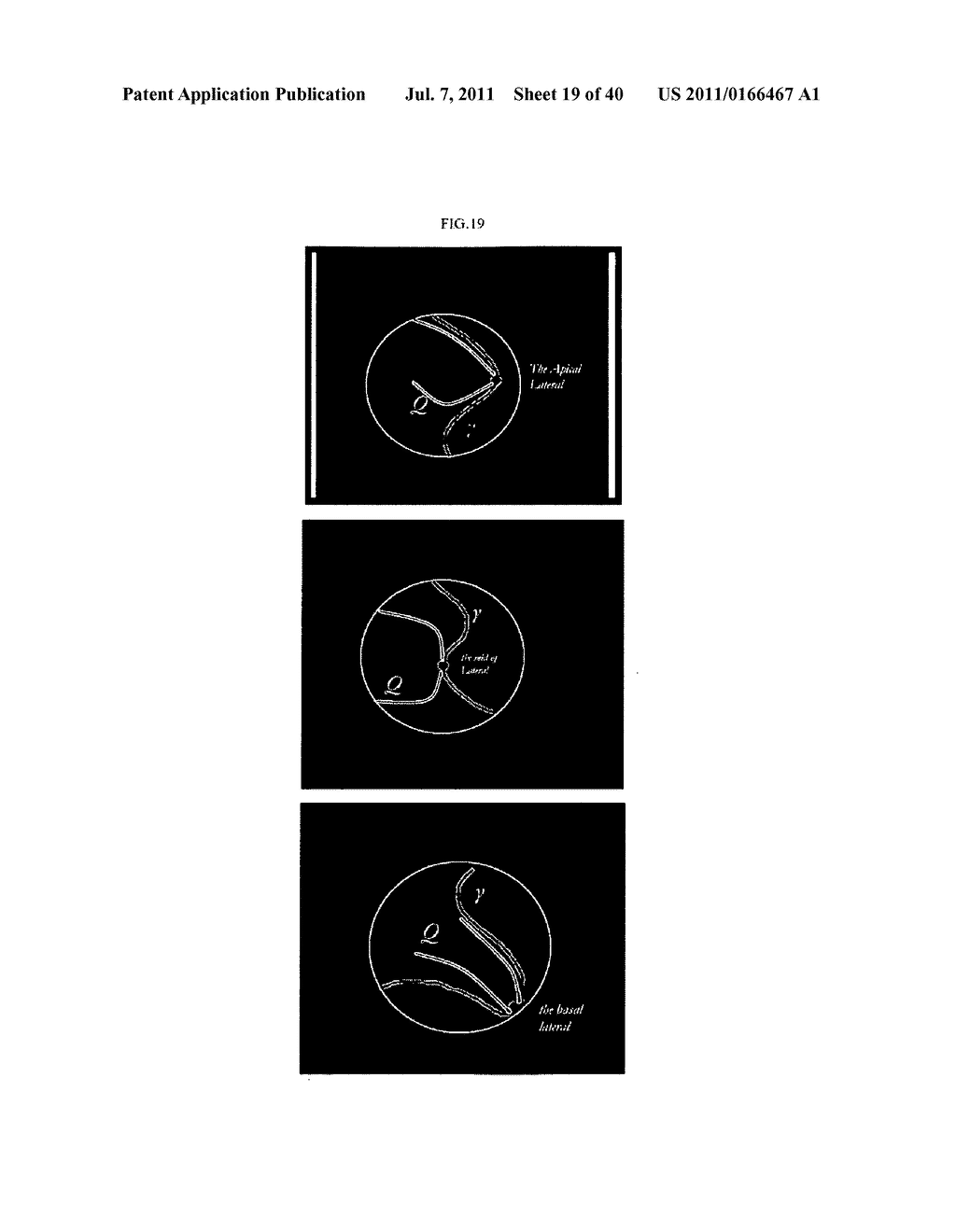 Solution Navier-Stocks Equations of the Blood as a Non-Newtonian Fluid in     the Left Ventricle - diagram, schematic, and image 20