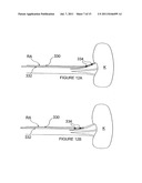 METHODS AND APPARATUS FOR INDUCING CONTROLLED RENAL NEUROMODULATION diagram and image