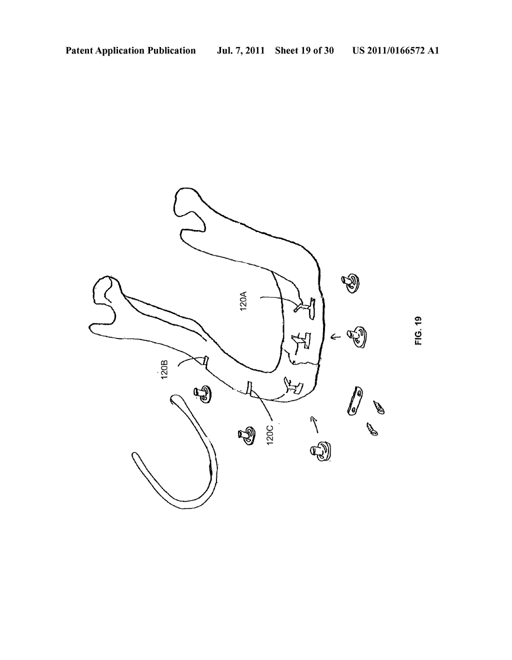 LATERAL IMPLANT SYSTEM AND APPARATUS FOR REDUCTION AND RECONSTRUCTION - diagram, schematic, and image 20