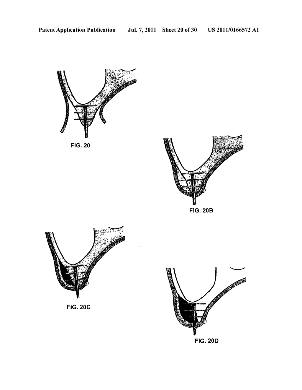 LATERAL IMPLANT SYSTEM AND APPARATUS FOR REDUCTION AND RECONSTRUCTION - diagram, schematic, and image 21