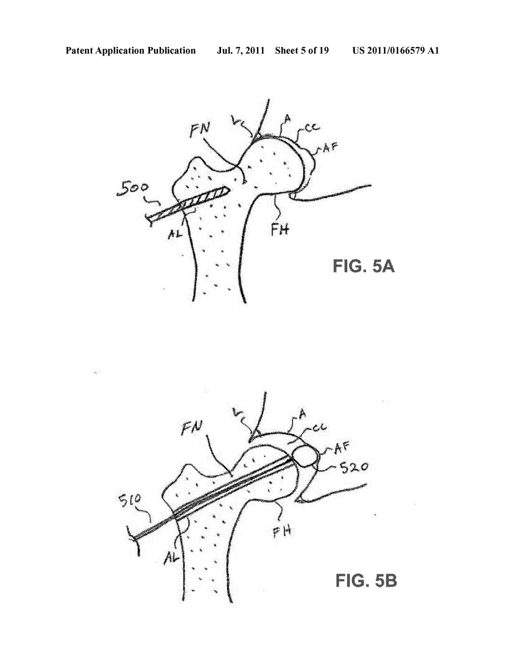 DEVICES AND METHODS FOR MINIMALLY INVASIVE ACCESS INTO A JOINT - diagram, schematic, and image 06