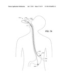 Endoscopic Device Delivery System diagram and image