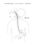 Endoscopic Device Delivery System diagram and image