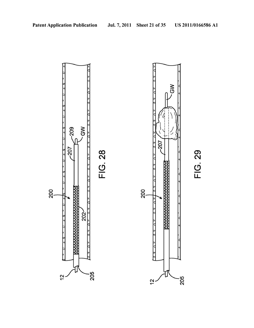 SYSTEMS, METHODS AND DEVICES FOR REMOVING OBSTRUCTIONS FROM A BLOOD VESSEL - diagram, schematic, and image 22