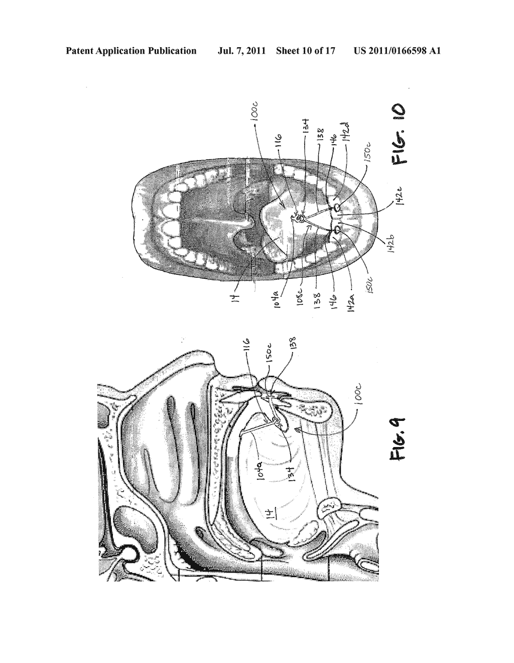 DEVICES AND METHODS FOR TONGUE STABILIZATION - diagram, schematic, and image 11
