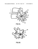 POSTERIOR DYNAMIC STABILIZATION OF SPINE diagram and image