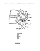 POSTERIOR DYNAMIC STABILIZATION OF SPINE diagram and image