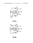 POSTERIOR DYNAMIC STABILIZATION OF SPINE diagram and image