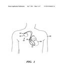 Pacemaker with neurocardiogenic syncope detection and therapy utilizing     minute ventilation input diagram and image