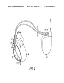 Pacemaker with neurocardiogenic syncope detection and therapy utilizing     minute ventilation input diagram and image