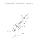 APPARATUS FOR FITTING A SHOULDER PROSTHESIS diagram and image