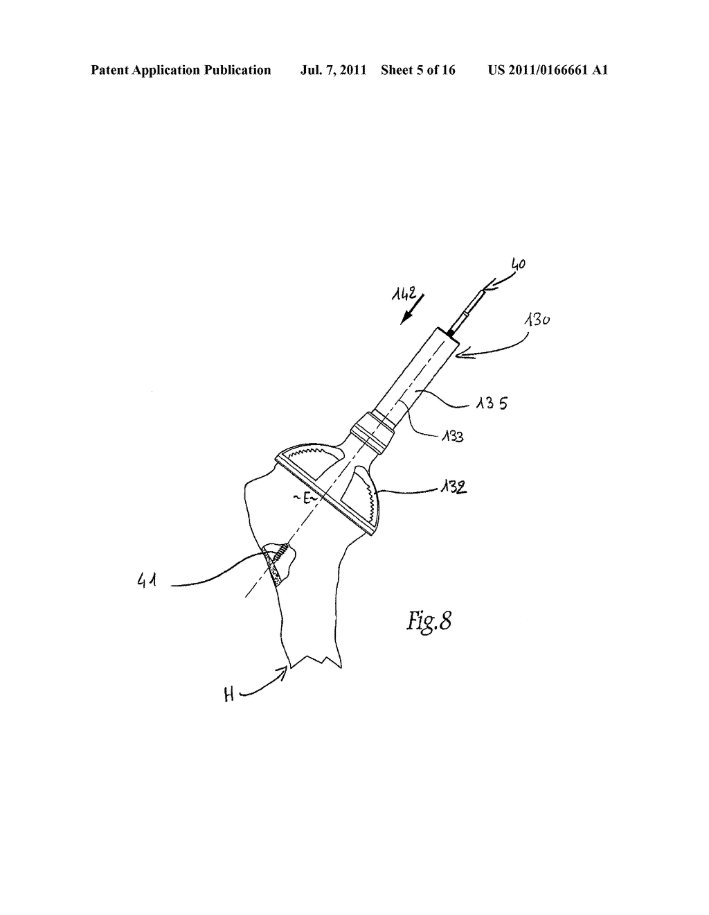 APPARATUS FOR FITTING A SHOULDER PROSTHESIS - diagram, schematic, and image 06