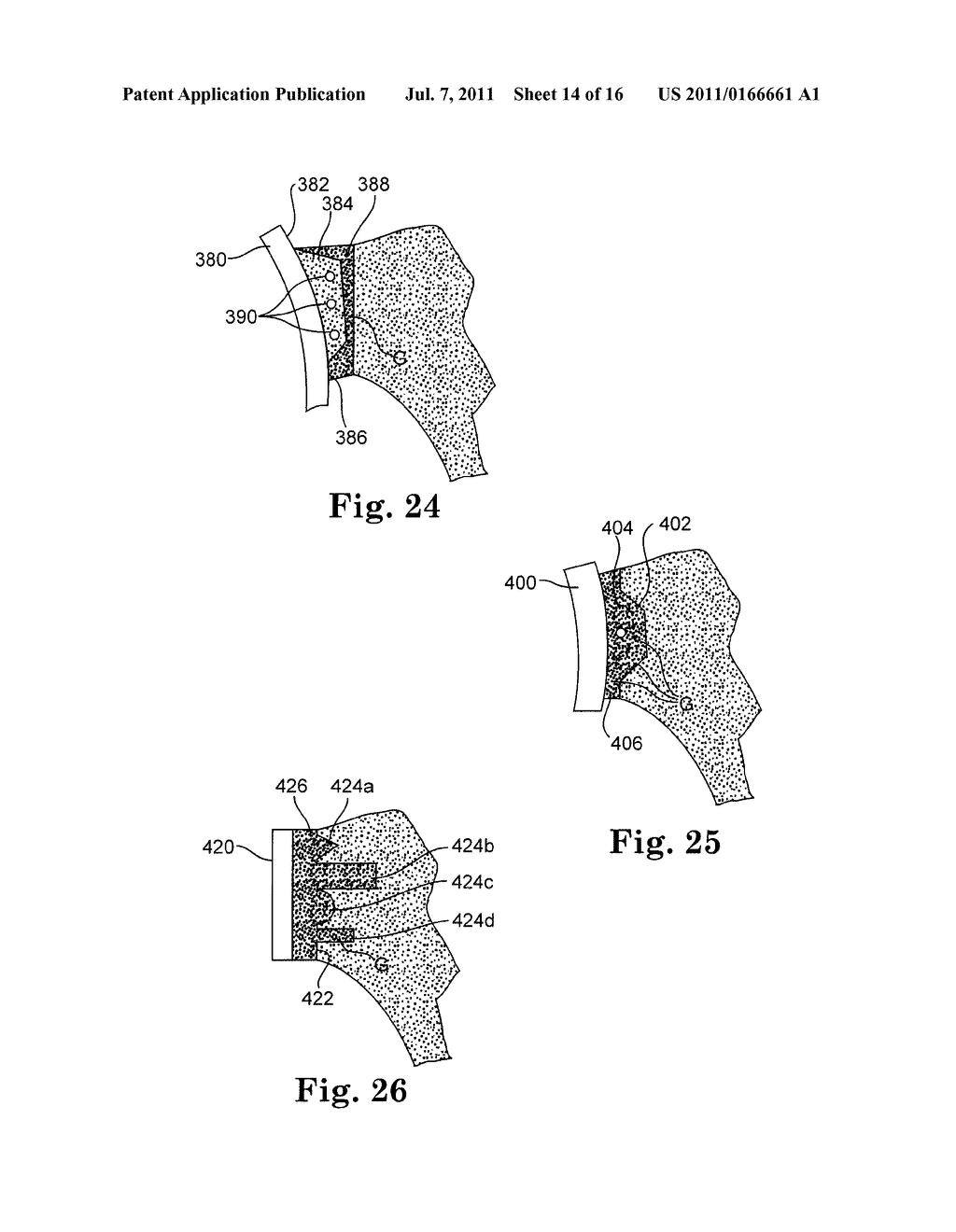 APPARATUS FOR FITTING A SHOULDER PROSTHESIS - diagram, schematic, and image 15