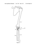 LATERAL ELBOW PROSTHESIS - PROXIMAL RADIOULNAR JOINT diagram and image