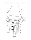 LATERAL ELBOW PROSTHESIS - PROXIMAL RADIOULNAR JOINT diagram and image