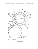 LATERAL ELBOW PROSTHESIS - PROXIMAL RADIOULNAR JOINT diagram and image