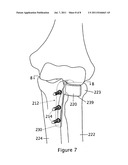 LATERAL ELBOW PROSTHESIS - PROXIMAL RADIOULNAR JOINT diagram and image