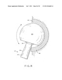 PROSTHETIC HIP IMPLANTS diagram and image