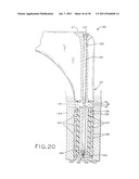 PROSTHETIC HIP IMPLANTS diagram and image