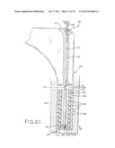 PROSTHETIC HIP IMPLANTS diagram and image