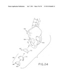 PROSTHETIC HIP IMPLANTS diagram and image