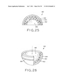 PROSTHETIC HIP IMPLANTS diagram and image