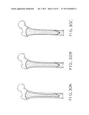 PROSTHETIC HIP IMPLANTS diagram and image