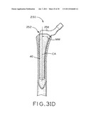 PROSTHETIC HIP IMPLANTS diagram and image