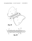 Interlocking Buttress Material Retention System diagram and image