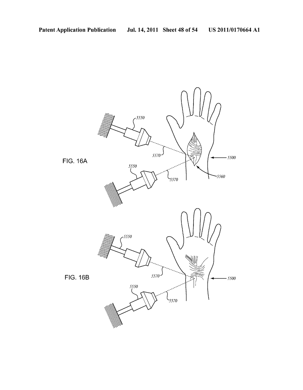 ORTHOVOLTAGE RADIOSURGERY - diagram, schematic, and image 49