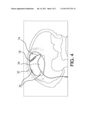 Systems and Methods for Treating Pain Using Brain Stimulation diagram and image