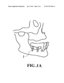 Bio-Implant Having a Screw Body with Nanoporous Spiral Groove and the     Method of Making the Same diagram and image