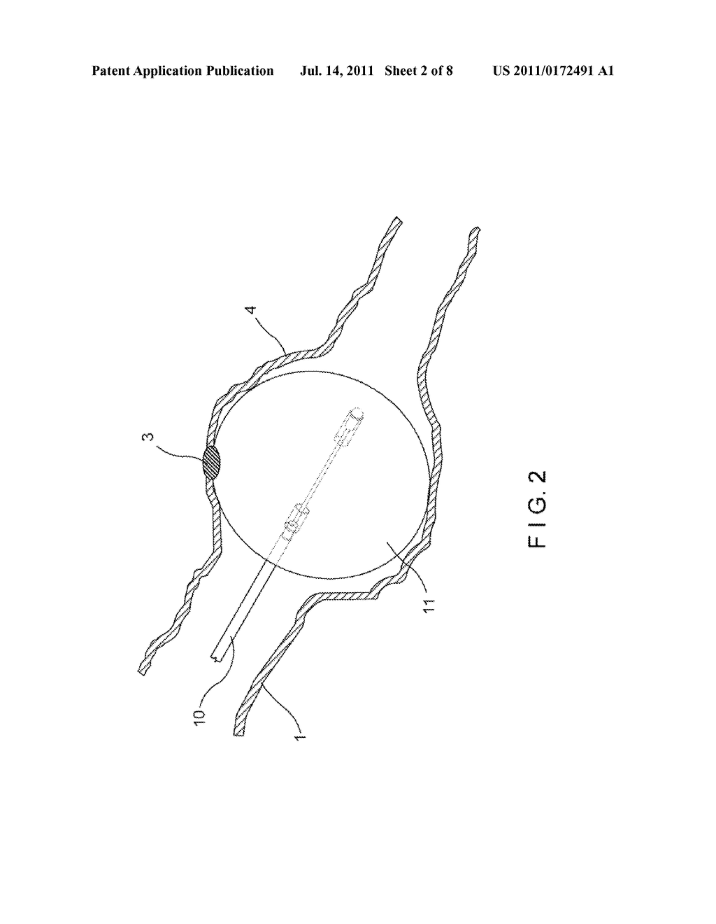 DETACHABLE BALLOON CATHETER - diagram, schematic, and image 03