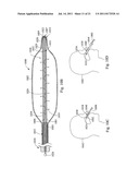 MULTIFILAR CABLE CATHETER diagram and image