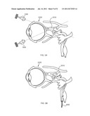 FLOW DIRECTED HEATING OF NERVOUS STRUCTURES diagram and image